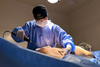 A lipoaspiração tradicional e a lipo HD possuem diferenças técnicas e indicações específicas, destaca Milton Seigi Hayashi.